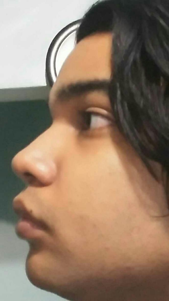Is my nose too wide and big? Do I need a nose job?
