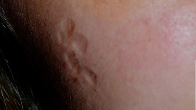 Is therr a way of getting rid of skin dents?