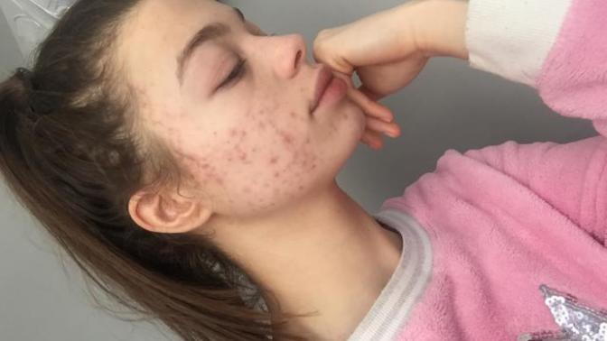Should I make a vlog about my acne?