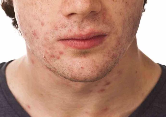 Do you suffer from adult acne?