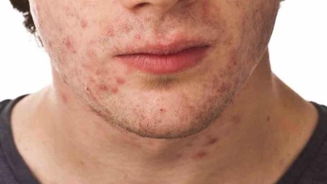 Do you suffer from adult acne?