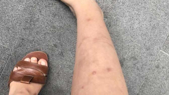 Girls, How bad does my leg look? Should I try tanning moderately?