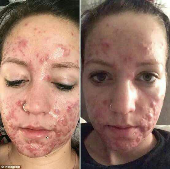 Would you date a person with severe acne?