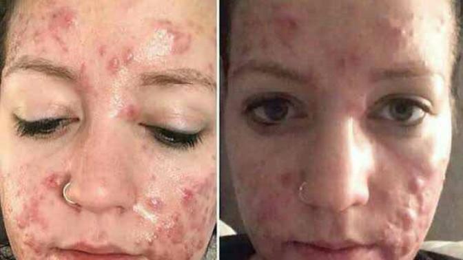 Would you date a person with severe acne?