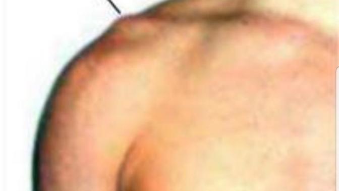 Does anyone else have bones on shoulders that stick out like this?