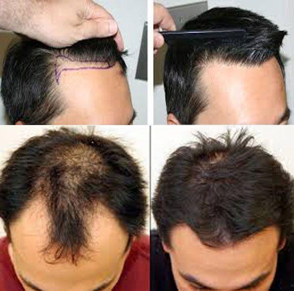 Go bald , hair transplant, or forhims. Which one would you pick if you was going bald?