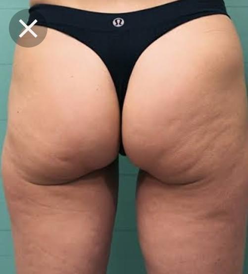 Is having cellulite normal?
