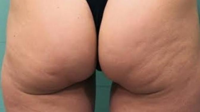 Is having cellulite normal?