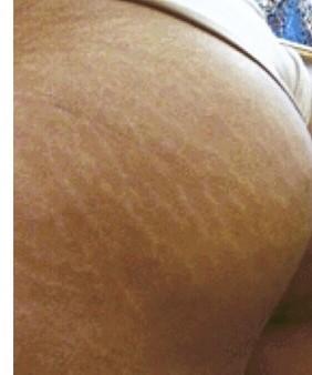 Girls, What do you think of a guy 22 years old with the butt covererd in stretch marks due to growth spurt?