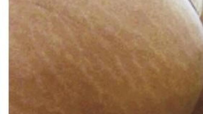 Girls, What do you think of a guy 22 years old with the butt covererd in stretch marks due to growth spurt?