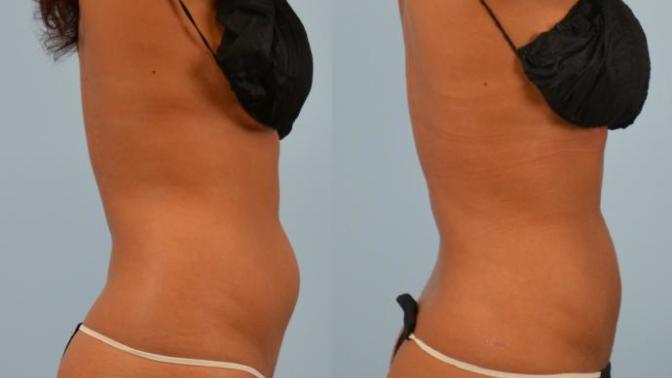 Is it unattractive if your stomach isn't perfectly flat?