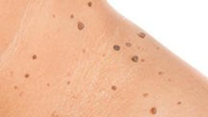 Why dont white care about moles on their body?