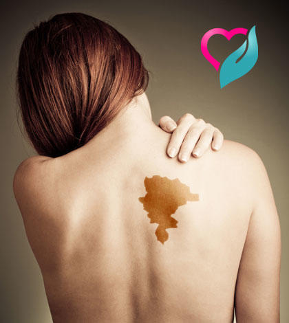 An Old (Fictional) Tale States That Your Birthmark Indicates Where You Were Killed In Your Past Life. Where Would You Have Been Killed?