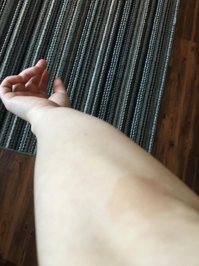 An Old (Fictional) Tale States That Your Birthmark Indicates Where You Were Killed In Your Past Life. Where Would You Have Been Killed?