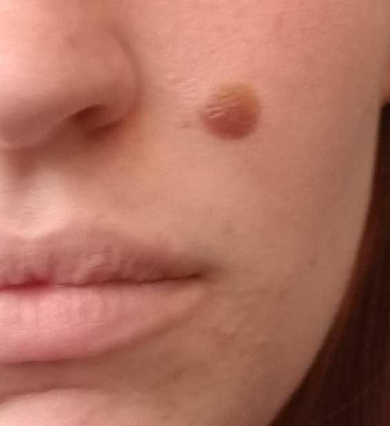 An Old (Fictional) Tale States That Your Birthmark Indicates Where You Were Killed In Your Past Life. Where Would You Have Been Killed?