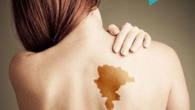 An Old (Fictional) Tale States That Your Birthmark Indicates Where You Were Killed In Your Past Life. Where Would You Have Been Killed?