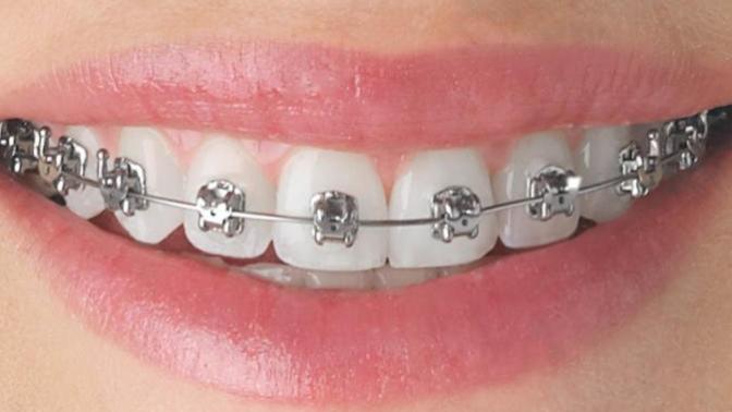 What it's like kissing someone who wears braces?