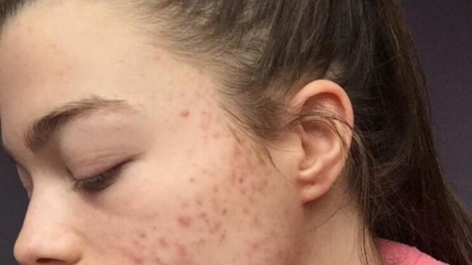 Guys, would you still find a girl attractive if she had acne?