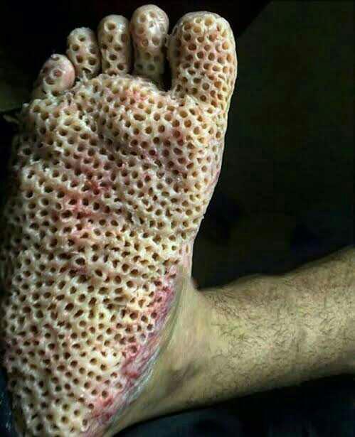 Guys do you have Trypophobia?