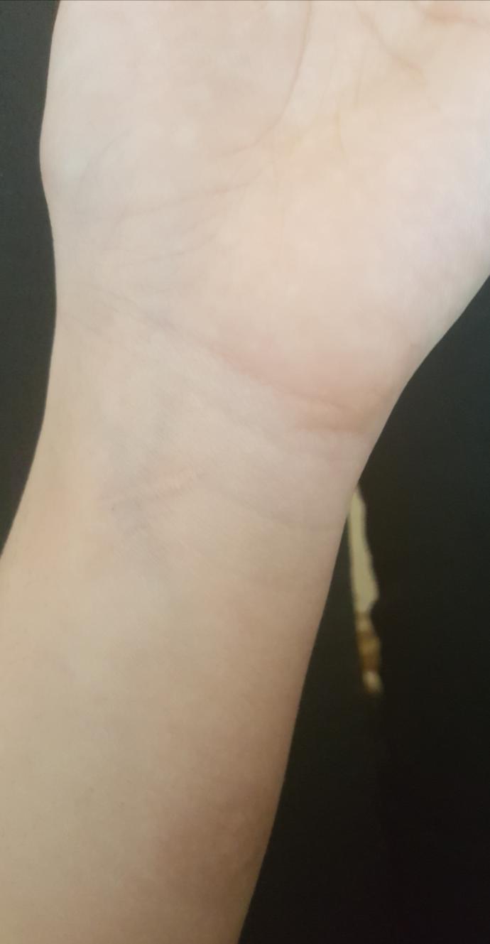 How can I get rid of my cut marks and burn scars?