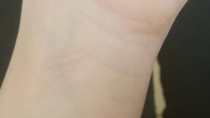 How can I get rid of my cut marks and burn scars?