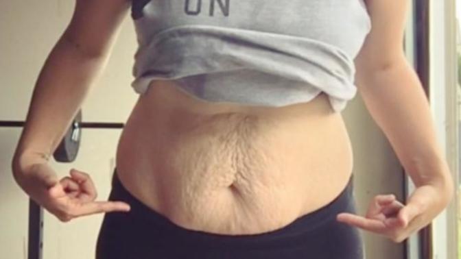 Guys, If you found out an attractive 8+/10 girl use to be fat and had loose skin& stretch marks when she took off her clothes, would this bother you?