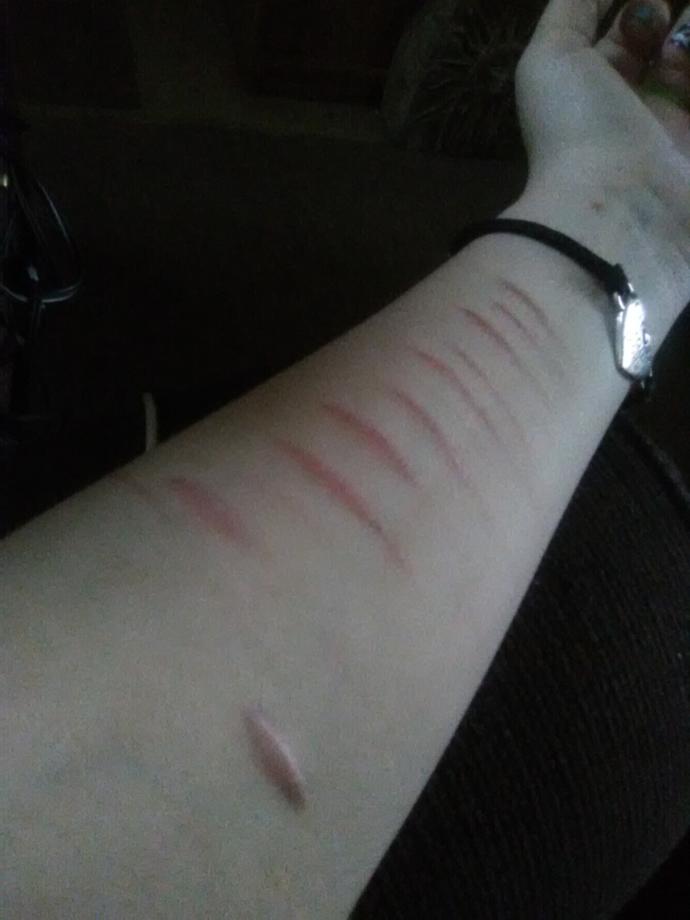 Do you think any (normal) guy would over look my self harm scars?