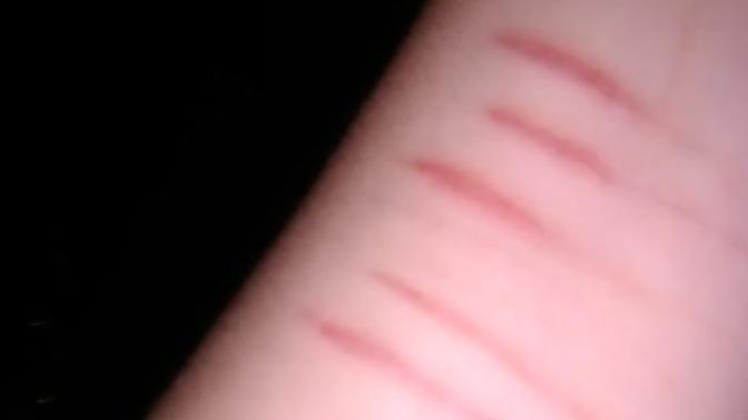 Do you think any (normal) guy would over look my self harm scars?