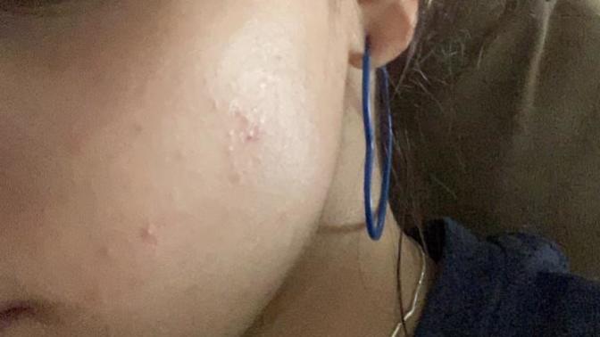 I feel like shit any skin advice for acne/bumps ?