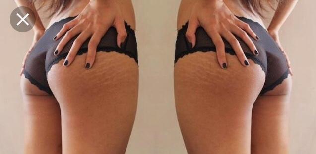 Are stretch marks a turn off? Please be honest?