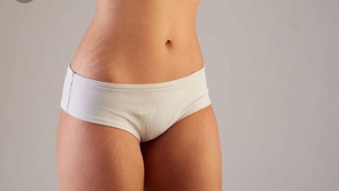 Are stretch marks a turn off? Please be honest?