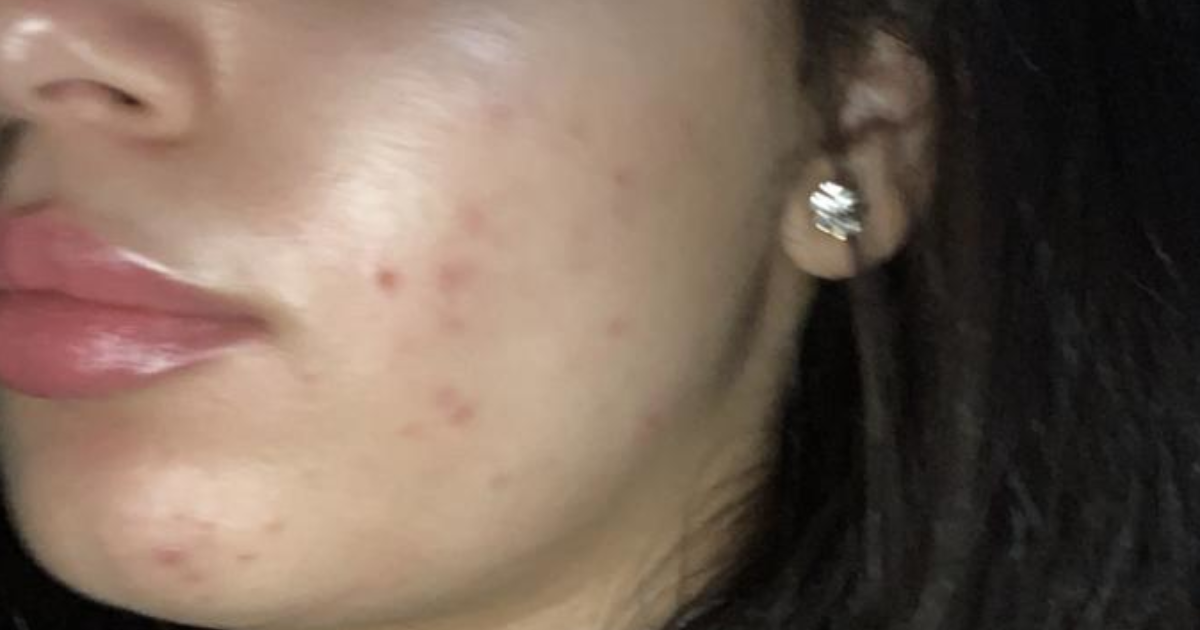 Is my acne really bad or am I overreacting? - GirlsAskGuys