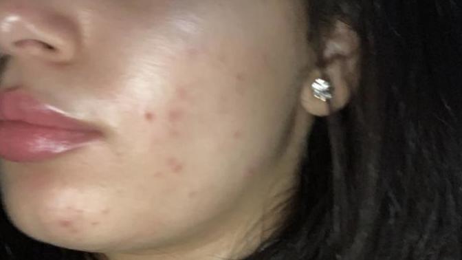 Is my acne really bad or am I overreacting?