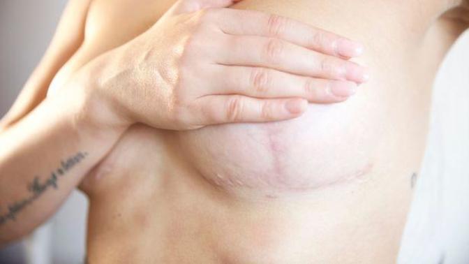 Men, what would you do if you saw plastic surgery scars around a girl's breasts?