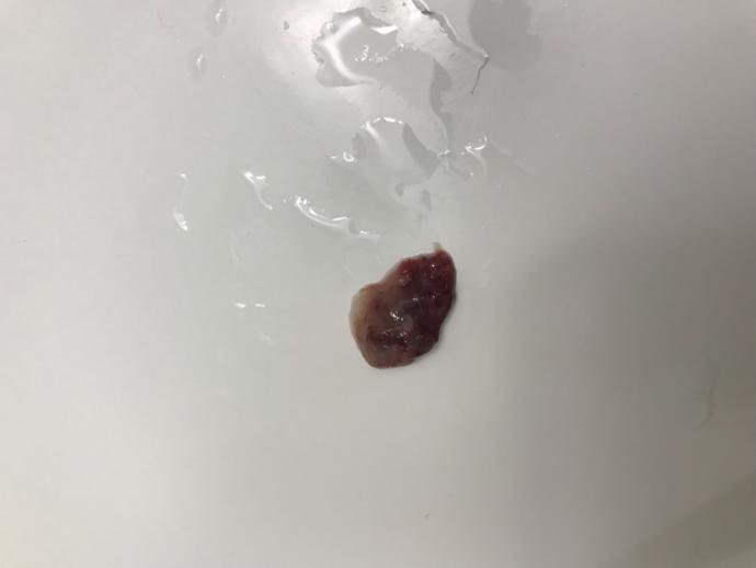 Okay, so I just blew this out of my nose, does this look normal?