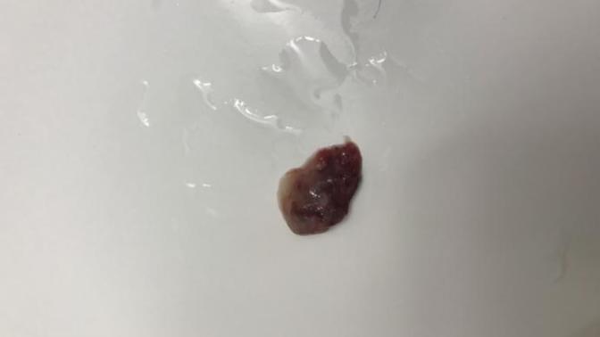Okay, so I just blew this out of my nose, does this look normal?