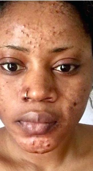 Guys, if a girl actually showed her true face on a dating app with acne, would you still date her?