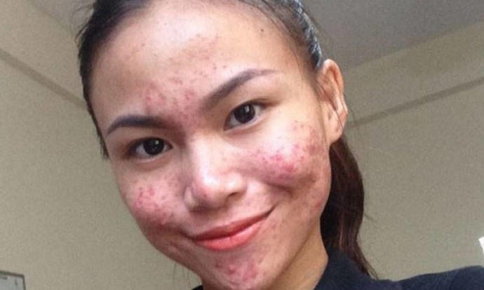 Guys, if a girl actually showed her true face on a dating app with acne, would you still date her?