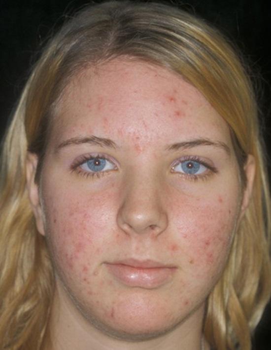 Guys, if a girl actually showed her true face on a dating app with acne, would you still date her?