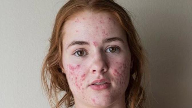 Guys, if a girl actually showed her true face on a dating app with acne, would you still date her?