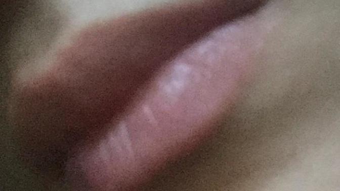Is this a cold sore?