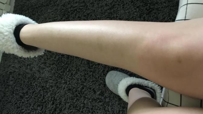 Bruises from boyfriend?