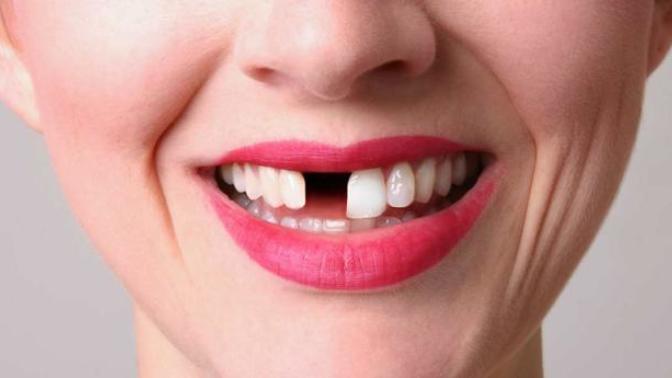 Is is true that everyone in New Jersey is missing a front tooth?