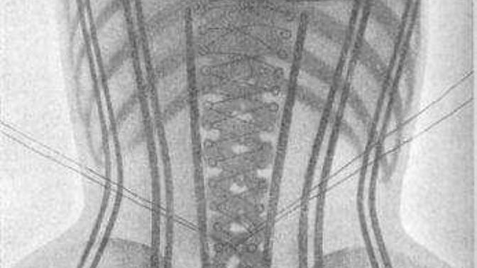 Would you rather have a rib remove or would you rather wear a corset 24 hours a day to achieve the hourglass figure?