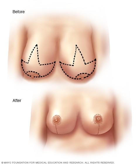 Girls, would you ever consider breast enlargement or reduction? Have you had either?