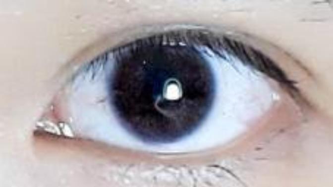 Do you have blue color ring at the outer of your eyes' irises? If so, do you think it's a symptom of sickness?