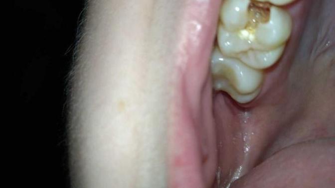 HELP WITH A TOOTH FILLING EMERGENCY ( GROSS PICS)?