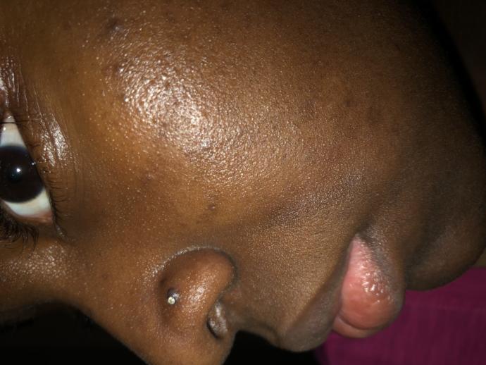 How do I get rid of this bump around my nose piercing?