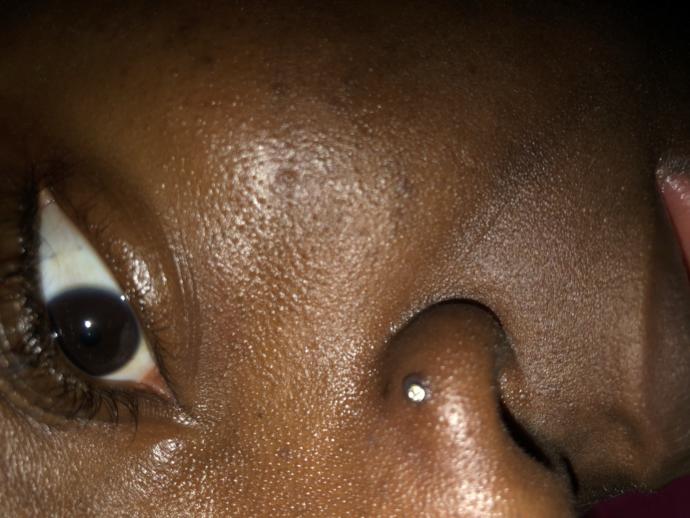 How do I get rid of this bump around my nose piercing?