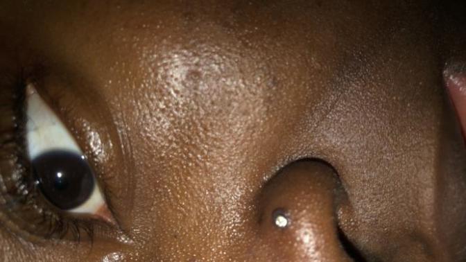 How do I get rid of this bump around my nose piercing?